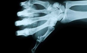 osteoporoz