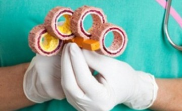 atherosclerosis