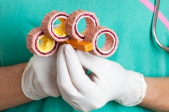 atherosclerosis